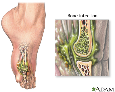 ورم استخوان (نام‌های دیگر: کورک استخوان، التهاب مغز استخوان، استئومیلیت (به انگلیسی: Osteomyelitis)) به معنی عفونت استخوان و مغز استخوان می‌باشد. تمام استخوان‌های بدن ممکن است دچار عفونت شوند.