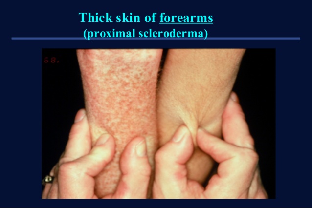بیماری «اسکلرودرمی» (Scleroderma) نوعی بیماری نادر و پیشرونده روماتیسمی است