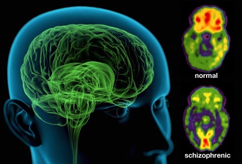 اسكيزوفرني‌  schizophrenic disorders  شرح بيماري و...