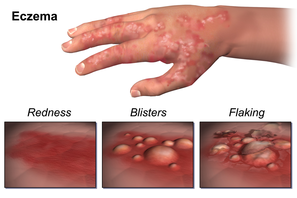اگزما : Eczema  شرح بيماري   علايم‌ شايع‌   علل‌ : پيشگيري‌...