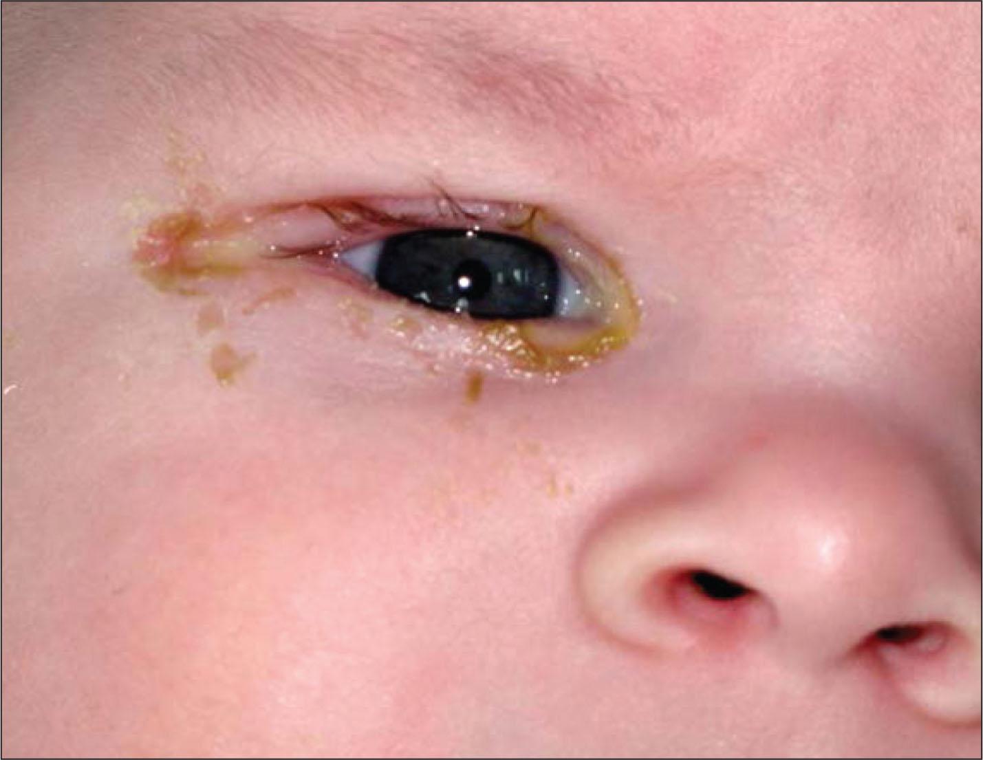التهاب ملتحمه یا کنژنکتیویت (Conjunctivitis) یا قرمزی چشم التهاب غشاء چشم است که بدلایل عفونی و یا غیر عفونی رخ می‌دهد. ملتحمه (conjunctiva) غشاء نازک و شفافی است که روی سفیدی چشم (صلبیه) و سطح داخلی پلک‌ها را پوشانده‌است.