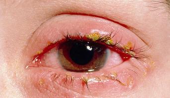 کنژنکتیویت معمولاً در یک معاینه ساده چشم پزشکی با استفاده از Slit Lamp تشخیص داده می‌شود. در بعضی از موارد چشم پزشک ممکن است برای تشخیص نوع باکتری عامل کنژنکتیویت ترشحات چشم را برای کشت به آزمایشگاه بفرستد.