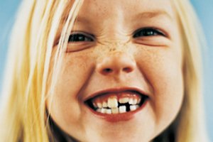 دندان شیری,عوارض کشیدن دندان شیری کودکان