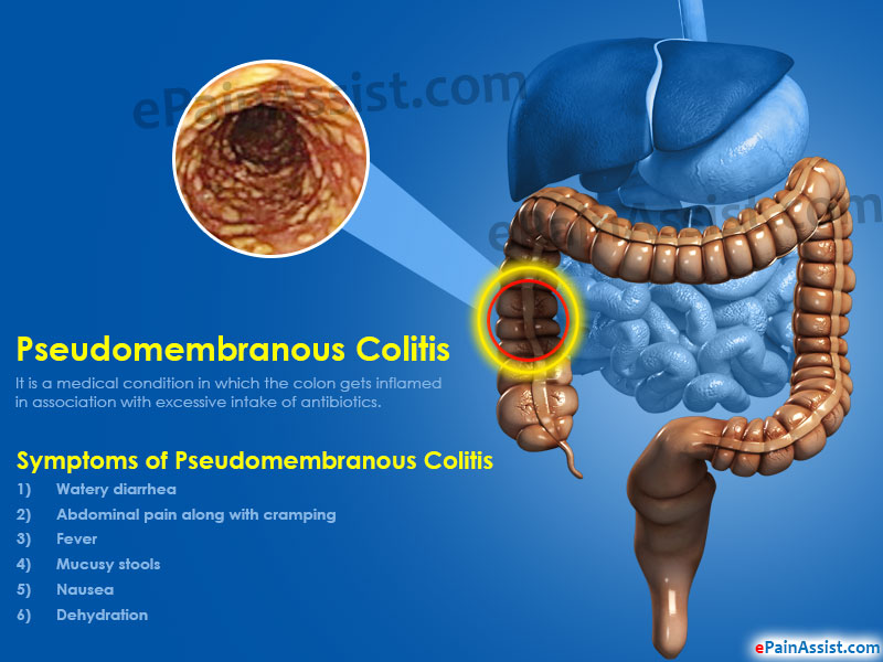 انتروكوليت‌ با غشاي‌ كاذب‌  pseudomembranous enterocolitis