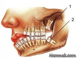 دندان عقل دردسرسازترین دندان در جهان