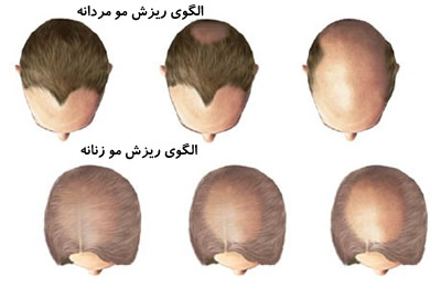 الگوهای ریزش مو,کچلی در مردان,کچلی در زنان,ریزش مو