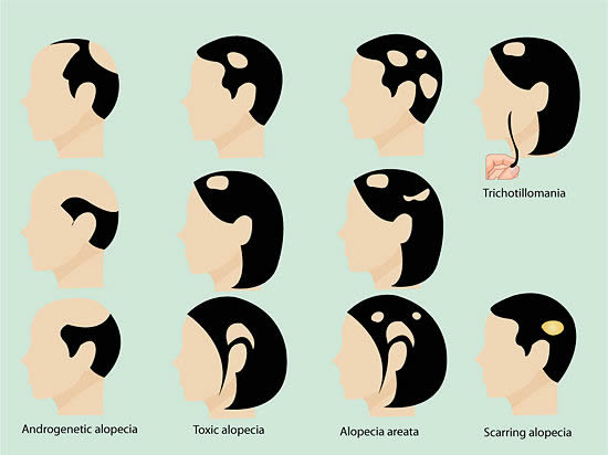 الگوهای ریزش مو,کچلی در مردان,کچلی در زنان,ریزش مو