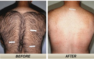 درمان دائمی و رفع موی زائد بدن با طب سنتی