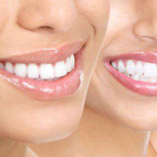 ارتودنسی نامرئی، متحرک و ثابت دندان: هزینه و مراحل