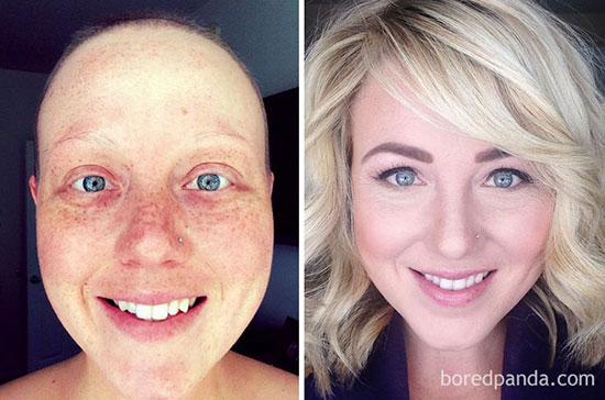 عکس‌ های قبل و بعد کسانی که با سرطان مبارزه کردند
