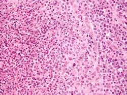 سلولیت چیست، چه علائمی دارد و چگونه درمان می شود؟