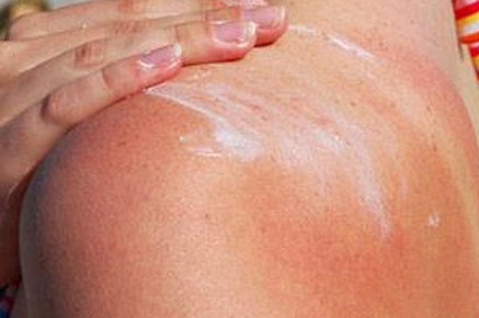 ۱۲ درمان طبیعی آفتاب سوختگی پوست صورت و بدن