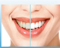 درمان زردی دندان با سفید کننده دندان