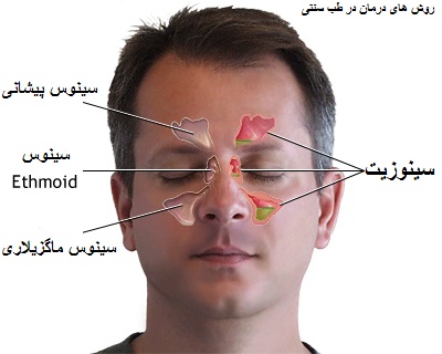 درمان سینوزیت(طب سنتی)