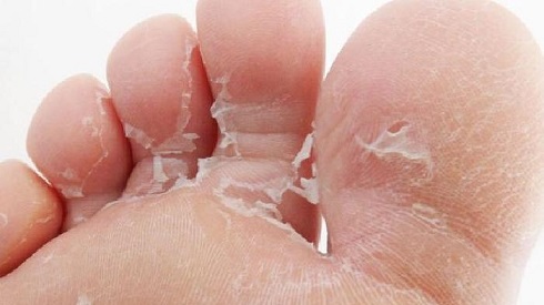  چرا پوست پای شما پوسته پوسته می شود