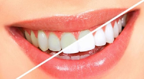  راه کارهای خانگی برای سفید کردن دندان ها