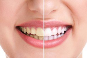 هفت ماده غذایی که دندان های تان را زرد می کنند