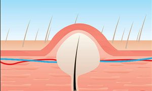 کیست مویی و درمان آن با لیزر