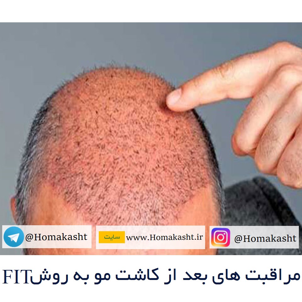 مراقبت‌های پس از کاشت مو به روش FIT