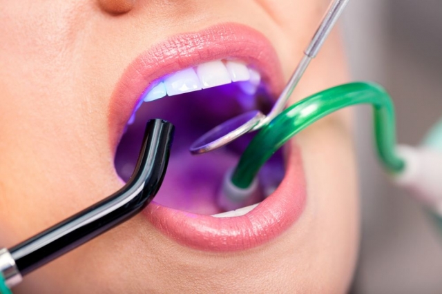 پر کردن دندان: علل، روش، هزینه و مراقبت های پس از ترمیم