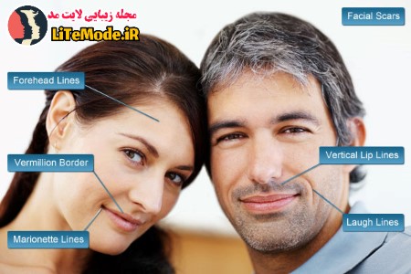 بعد از تزریق ژل خط خنده, تزریق ژل خط خنده,قیمت تزریق ژل خط خنده,