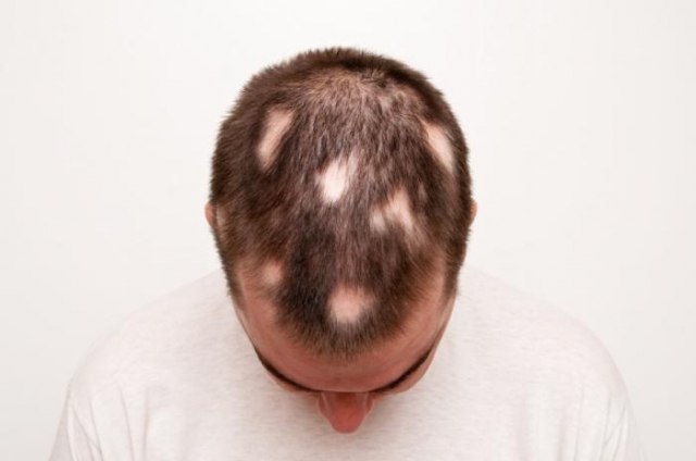 ریزش سکه ای مو: علل و راه درمان