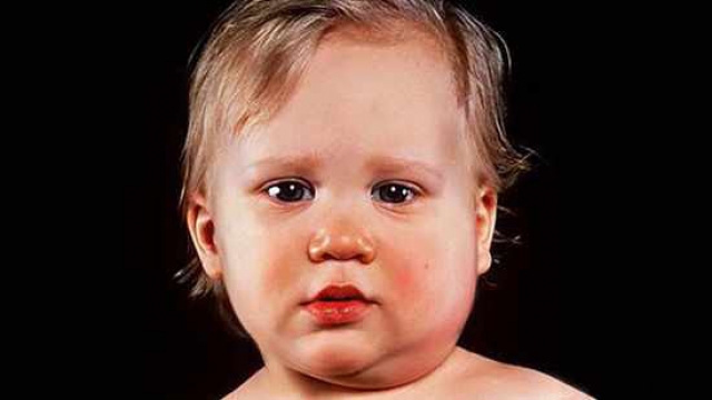 بیماری اوریون در کودکان: علل، علائم، عوارض، راه پیشگیری و درمان