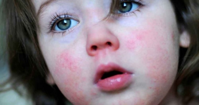 بیماری مخملک در کودکان: علل، علائم، عوارض و راه درمان