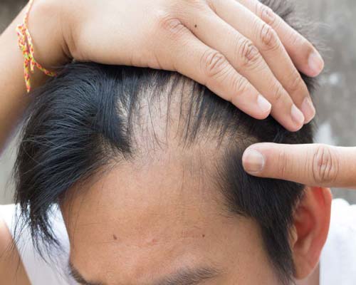 ریزش مو چیست، علل و روش تشخیص آن