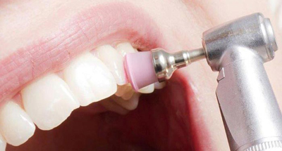 بروساژ دندان چیست و چگونه انجام می شود؟