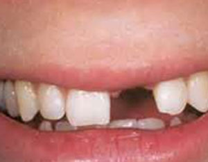 درمان بی‌دندانی, بریج چیست, کشیدن دندان
