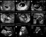 عوارض سونوگرافی در دوران بارداری