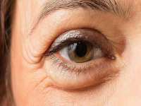 پف زير چشم چه علتي دارد و چگونه درمان مي شود؟