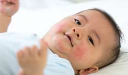 قارچ پوستي در کودکان علت و درمان