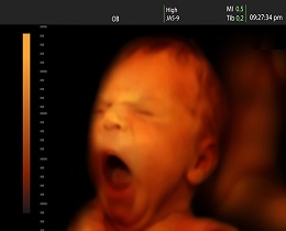 سونوگرافی رنگی در بارداری