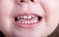 علت سياه شدن دندان هاي کودک چيست؟