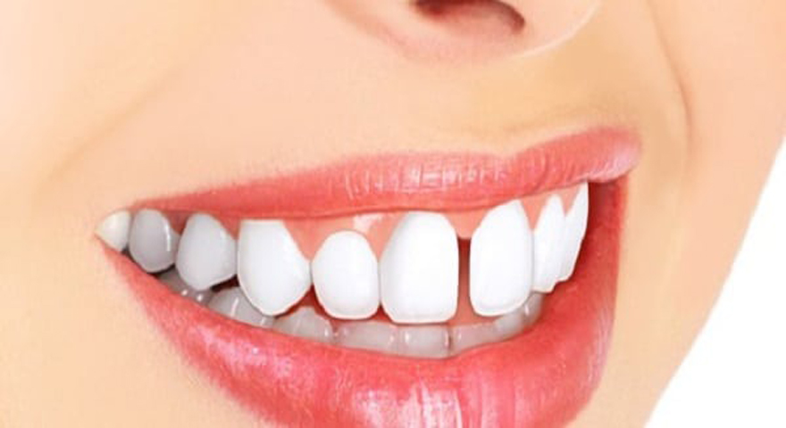 اصلاح و بستن فاصله بین دندانی بدون ارتودنسی