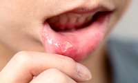 آفت دهان را با روش هاي خانگي درمان کنيد / درمان آفت دهان