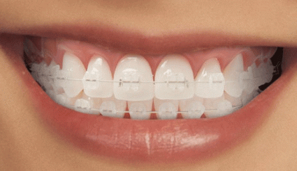 ارتودنسی سرامیکی یا همرنگ دندان