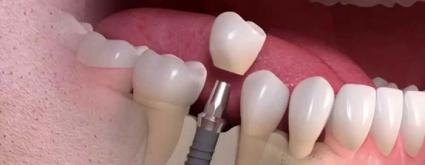 درد ایمپلنت دندان