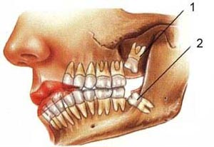 مواظب عوارض دندان عقل باشید