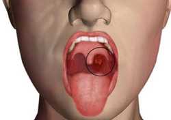 نشانه هاي سرطان دهان را بشناسيد