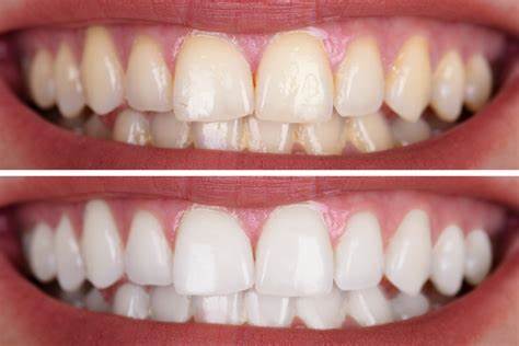 سوالات درباره سفید کردن دندان ها