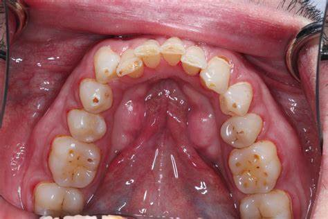 آنچه شما باید در مورد فرسایش دندان بدانید