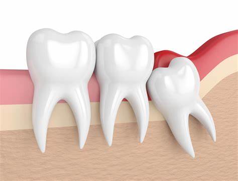 دندان عقل چیست؟ چه مشکلاتی ایجاد می کند؟