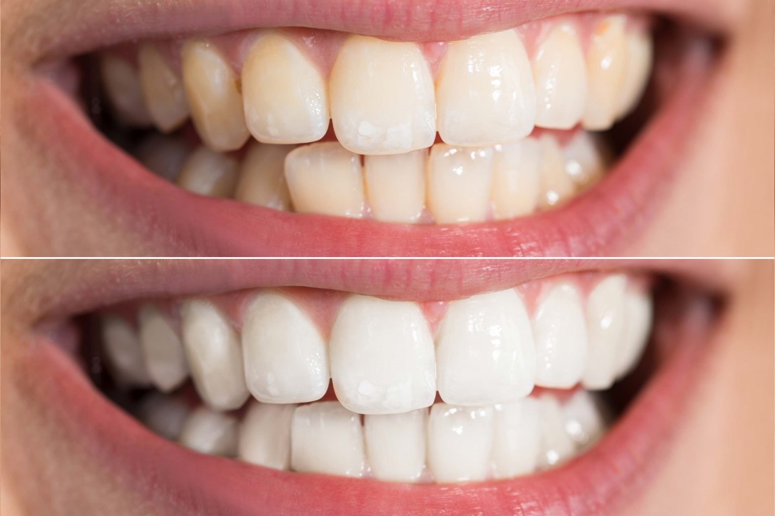 چگونه زردی دندان را از بین ببریم؟