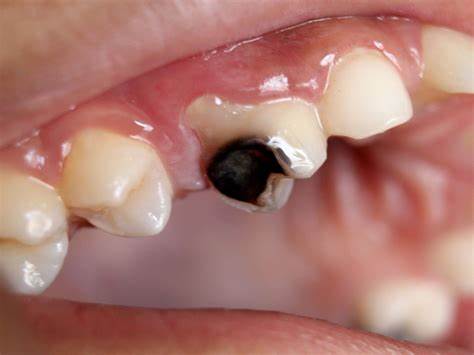 پوسیدگی دندان و دندان درد