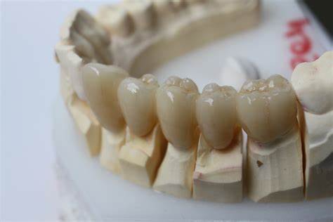 انواع دندان زیرکونیوم کدامند؟ چگونه انجام می شود؟