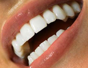 روش های سفید کردن دندان, سفیدی دندان ها