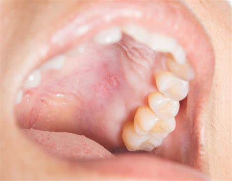 کمبود دندان در دهان